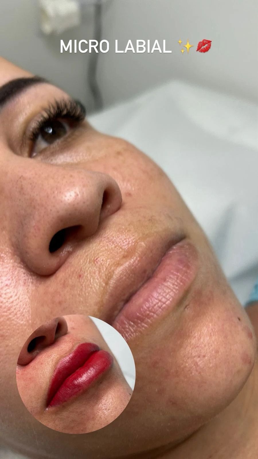 Resultado de micro labial