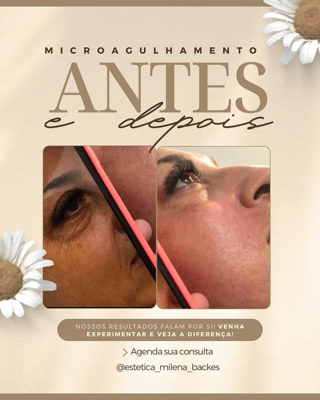 Antes e depois de microagulhamento