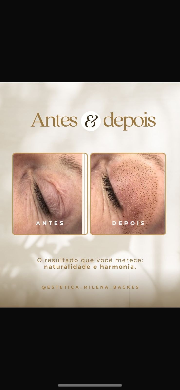 Antes e depois região dos olhos